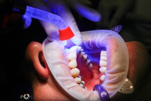 dentist, facet, uv light, curing, teeth, mouth, treatment, uv lamp, patient, clinic, dentist, dentist, dentist, dentist, dentist, teeth